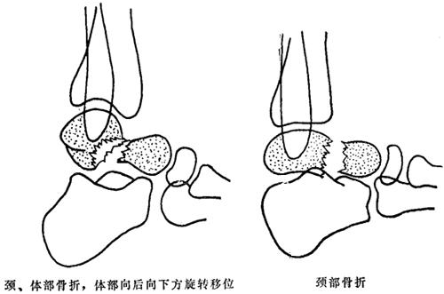 距骨骨折