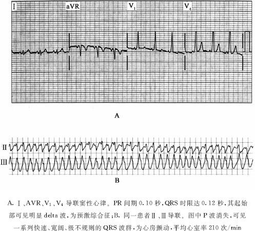 快速性心律失常 - 心血管内科疾病诊断标准 - 岁年网